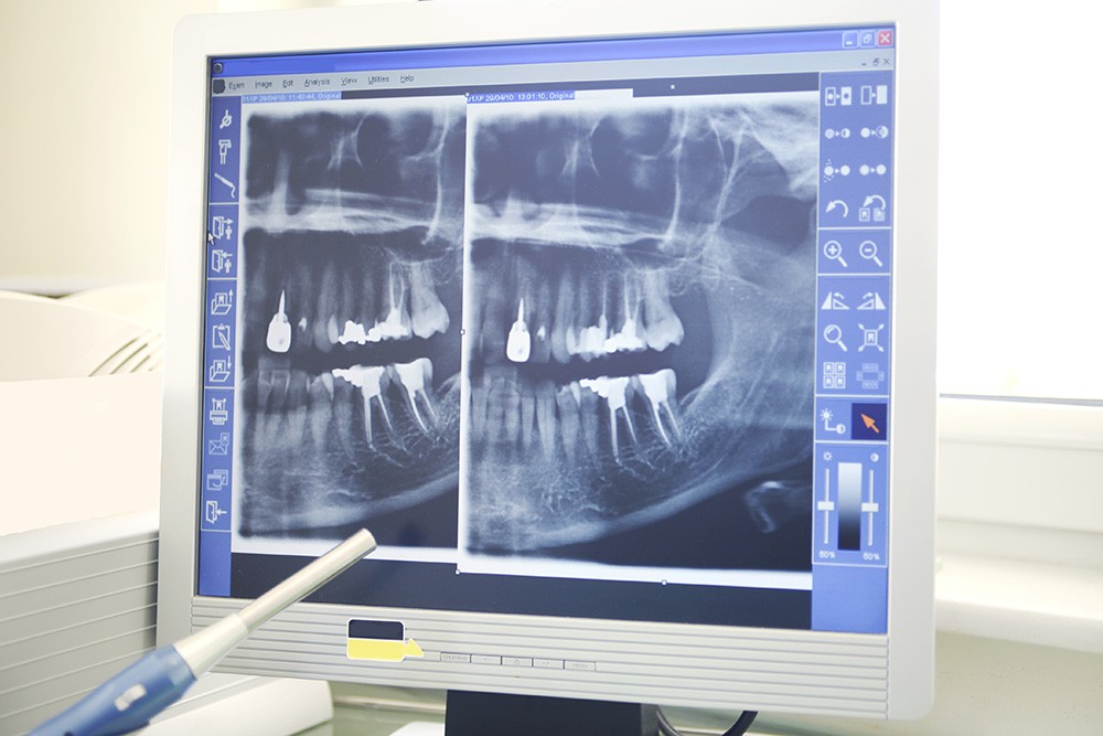 Complete-smile-dental-X-rays-Of-Dental-the-gap-dentist