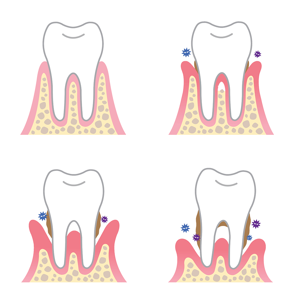 How periodontal (gum) disease causes tooth loss