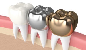 The-gap-dentist-Crowns-dental-clinic