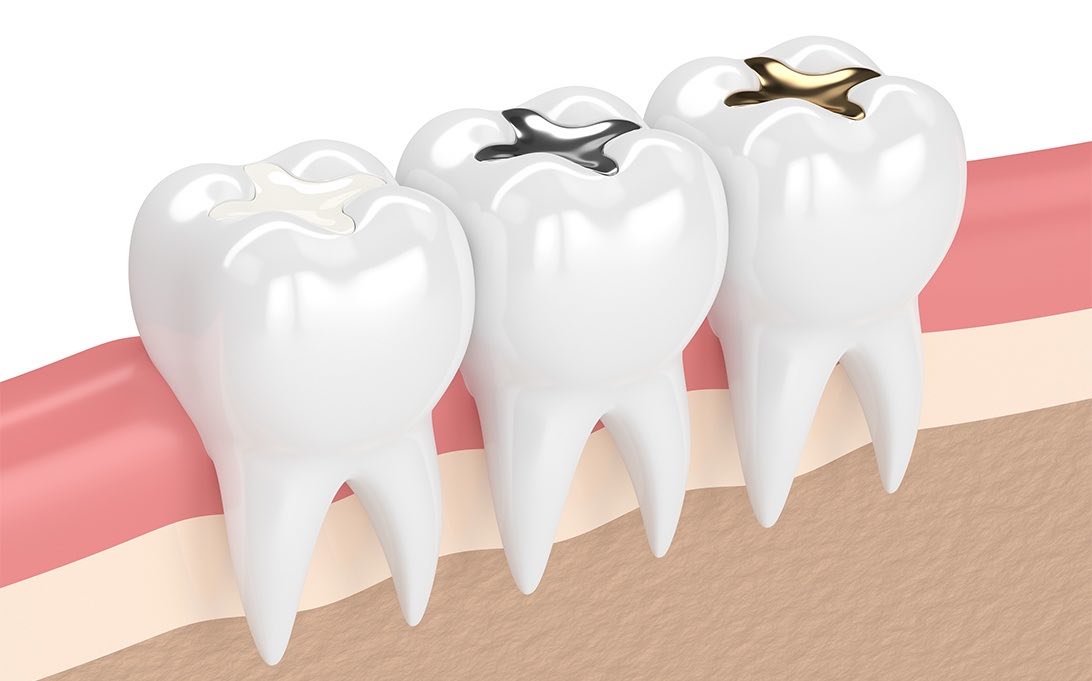 What type of filling do you need for your cavity?