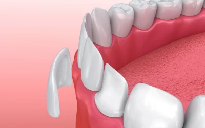 How can Invisalign before veneers improve treatment outcomes?