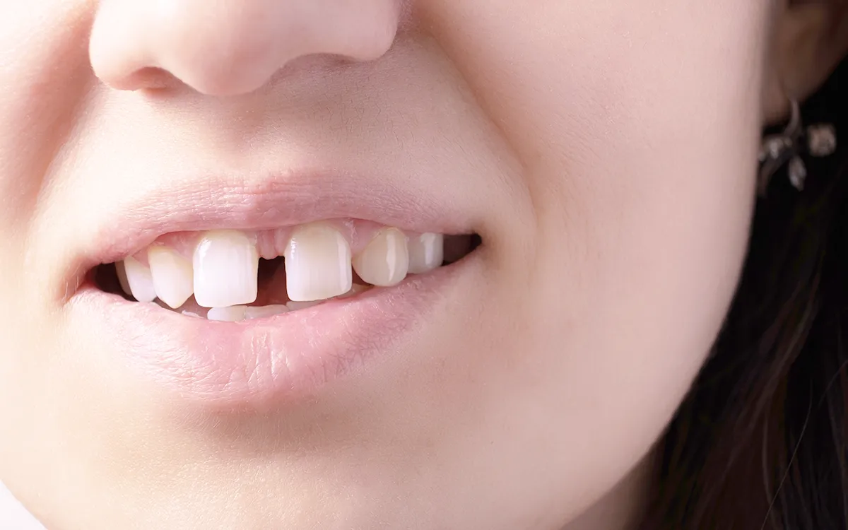 tooth gap