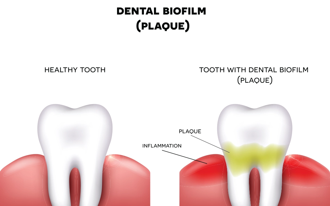 How quickly does dental plaque grow and why is it a real danger