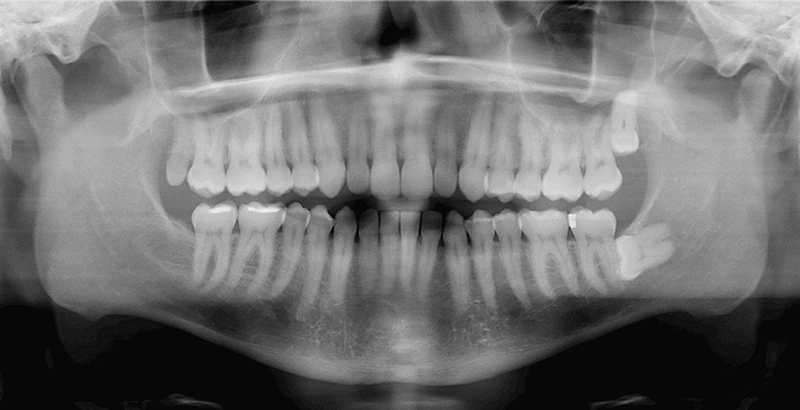 Is it just a growing pain or a wisdom tooth emergency