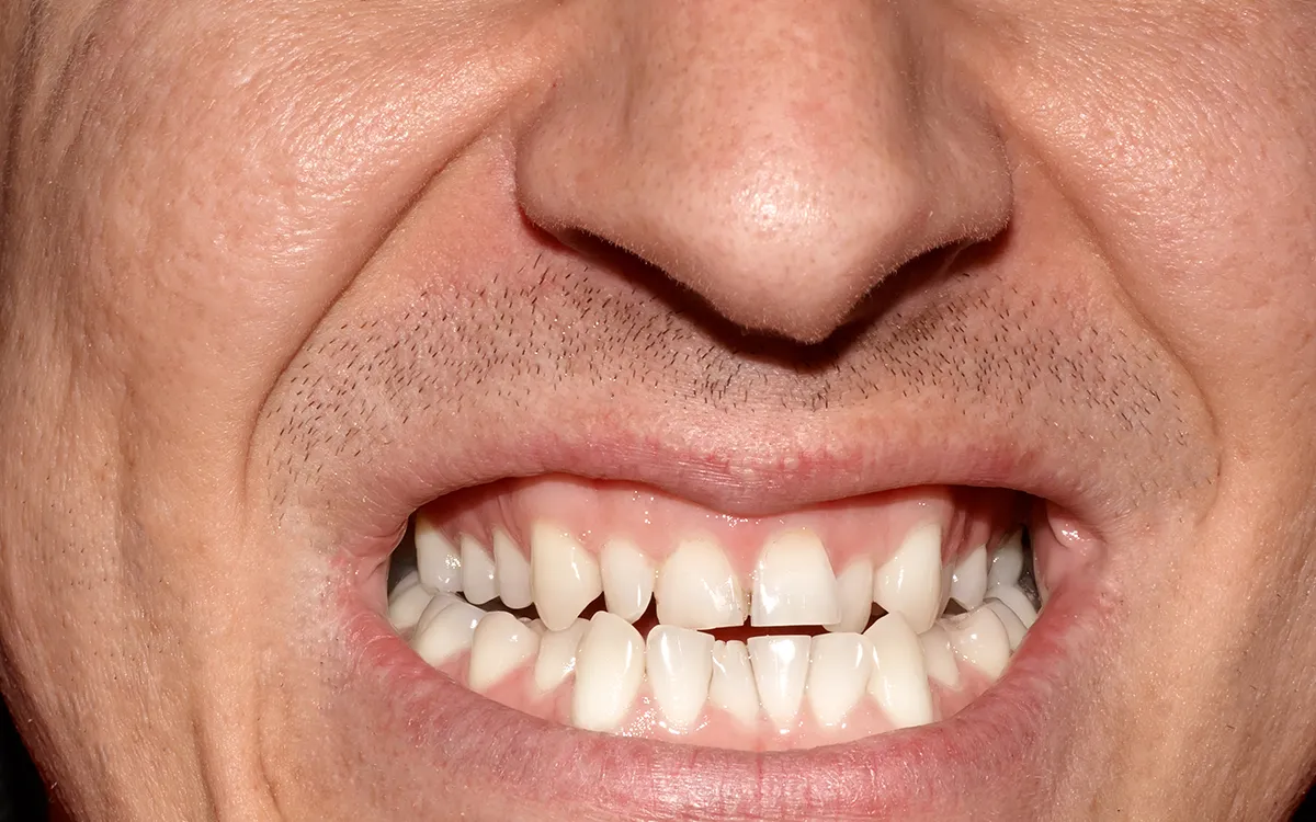 Crooked teeth