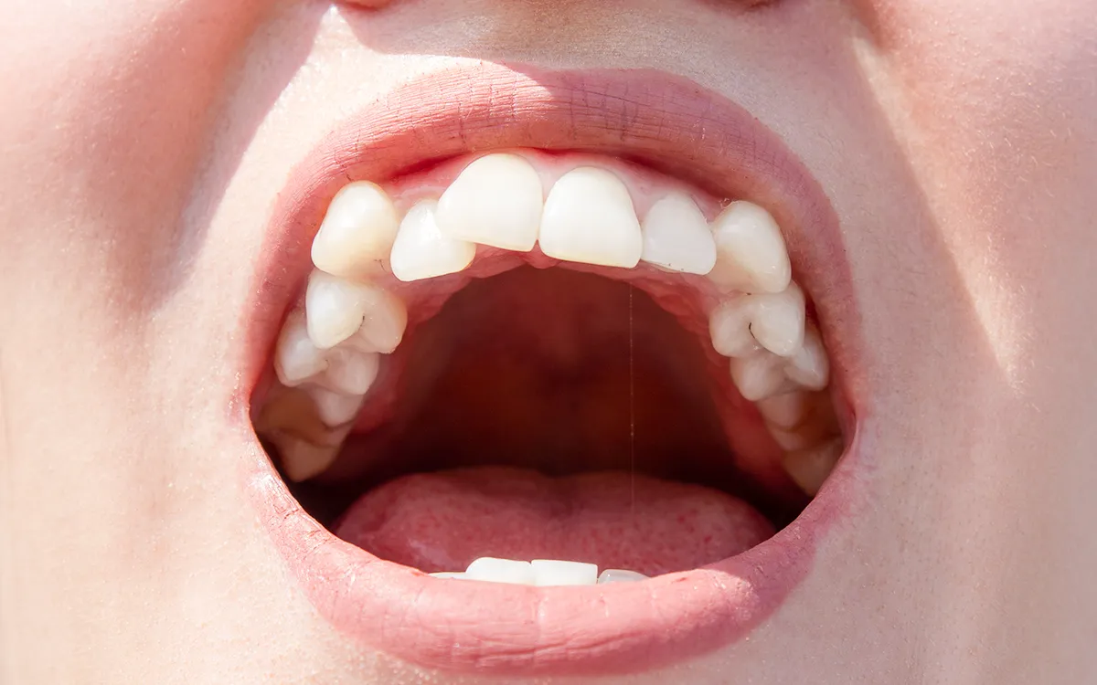 uneven bite 